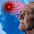 El Alzheimer: una de las enfermedades neurodegenerativas más temidas